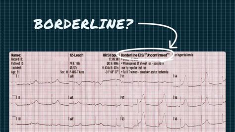 what does borderline ecg mean on ekg